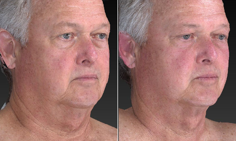 man neck lift before and after ultraslim treatment